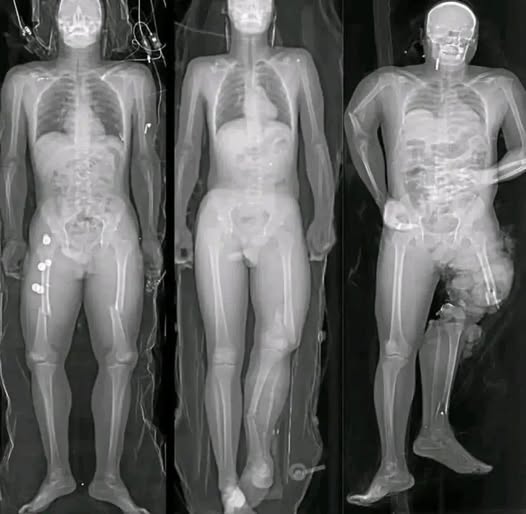 COVID-19. Global alert: Vaccinated individuals discover new cancer…See more