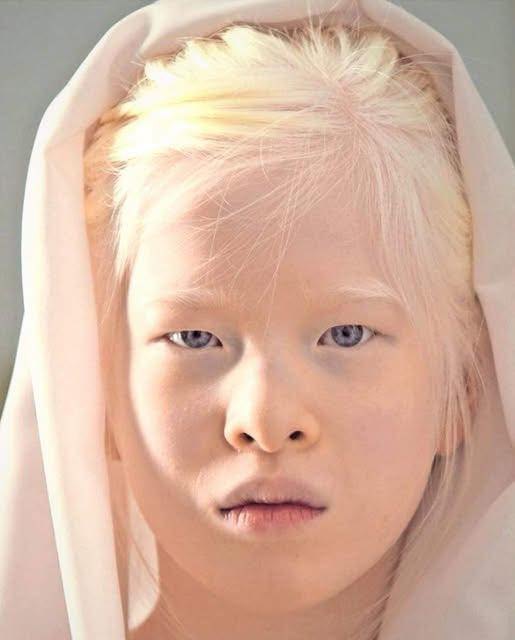 A baby girl born with albinism was abandoned by her parents. They left her at an orphanage door because she looked too “strange” for them. Try not to smile when you see her today: Check in comments 😢