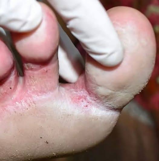 Looks like a infection between my toes. Can’t get medical advice for now. Any over-the-counter remedies?. Full article 👇 💬