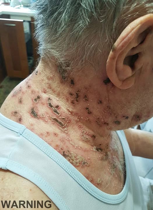 This is the silent disease that is triggered when you come into contact with … See more