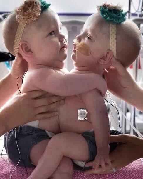 The twin sisters were born joined at the chest and abdomen: you will be shocked when you see them after the separation