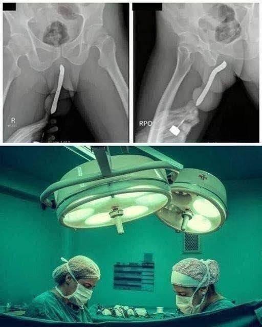 Girl had to be hospitalized for wanting to use a pe…Read full story in c0mment