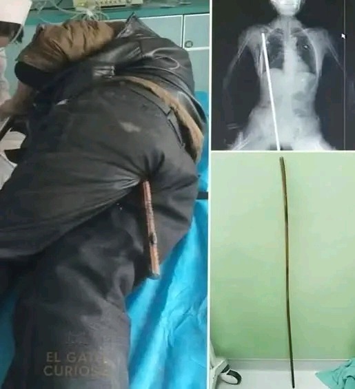 Young girl hospitalized after using dance pole as a pe…See more